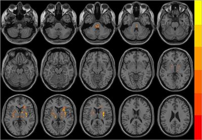 Regional brain dysfunction in insomnia after ischemic stroke: A resting-state fMRI study
